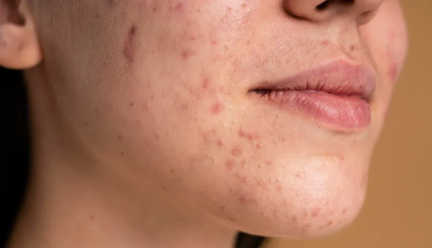 Acne ormonale e modi per trattarlo