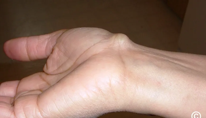 Come eliminare efficacemente un ganglion fastidioso?