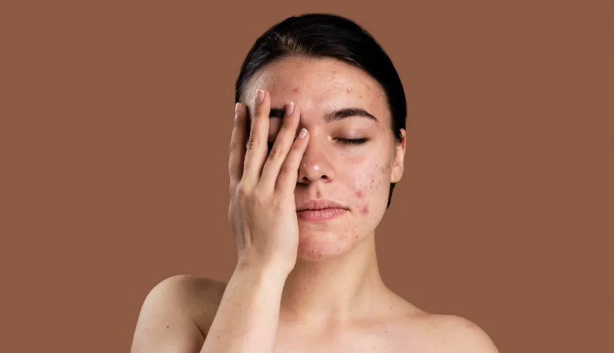 Come eliminare i dolorosi noduli sottocutanei causati dall'acne