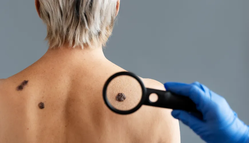 Proteggete la pelle dal sole e prevenite il melanoma